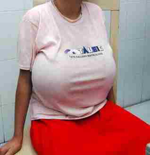 女童患上巨乳症 胸部疯长比成年人的还大