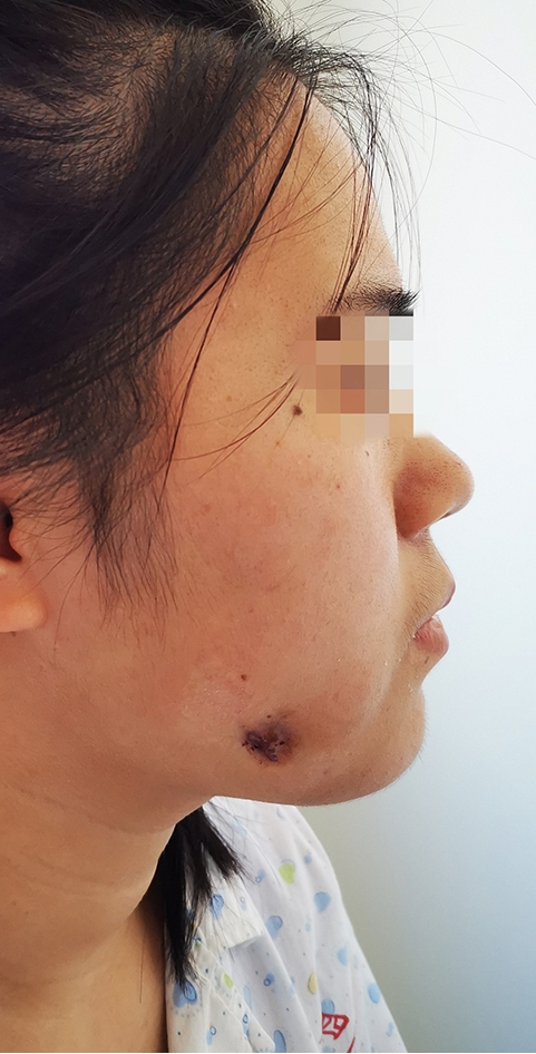 花季少女牙齿发炎差点毁容哈医大四院专家提醒反复牙疼提防面颊瘘